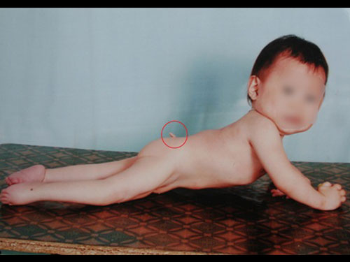Bé gái 2 tuổi mọc “đuôi”