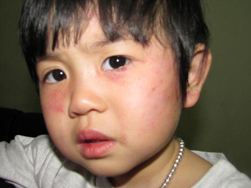 Bé 2 tuổi bị cô đánh bầm dập