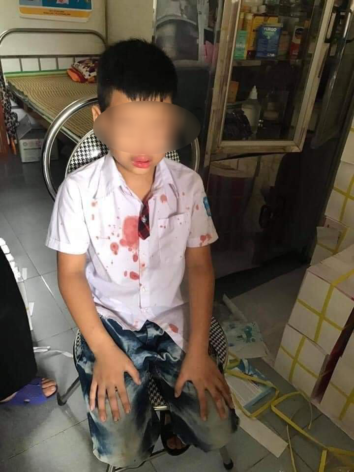 Ch&aacute;u N.G.K chảy nhiều m&aacute;u sau khi bị h&agrave;nh hung.