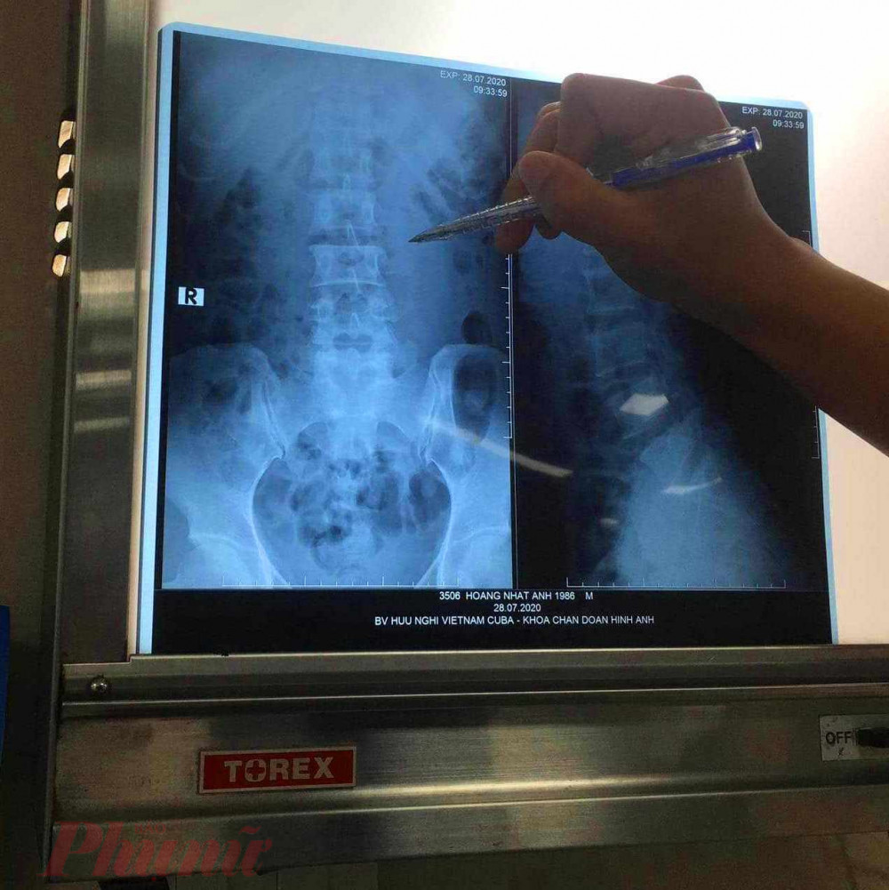 Bệnh viện Việt Nam - Cu Ba, chụp CT được chẩn đo&aacute;n g&atilde;y m&otilde;m ngang L2, L3 b&ecirc;n tr&aacute;i đốt sống; khuyết eo L4, L5 cả hai b&ecirc;n