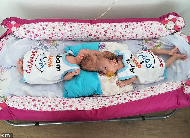 Cặp song sinh d&iacute;nh liền 17 th&aacute;ng tuổi Yigit v&agrave; Derman - Ảnh: Daily Mail