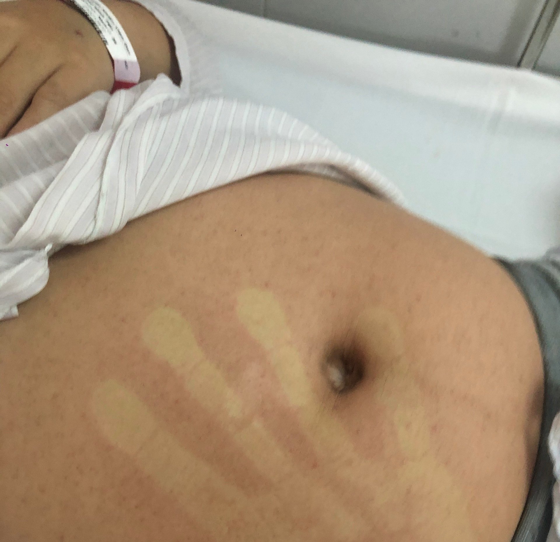 H&igrave;n hảnh ph&aacute;t ban ở bụng của bệnh nh&acirc;n