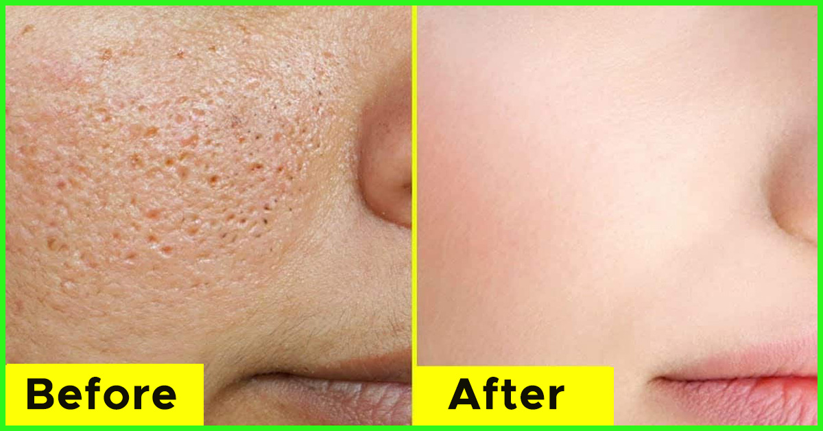 Mặt nạ đu đủ gi&uacute;p se kh&iacute;t lỗ ch&acirc;n l&ocirc;ng: