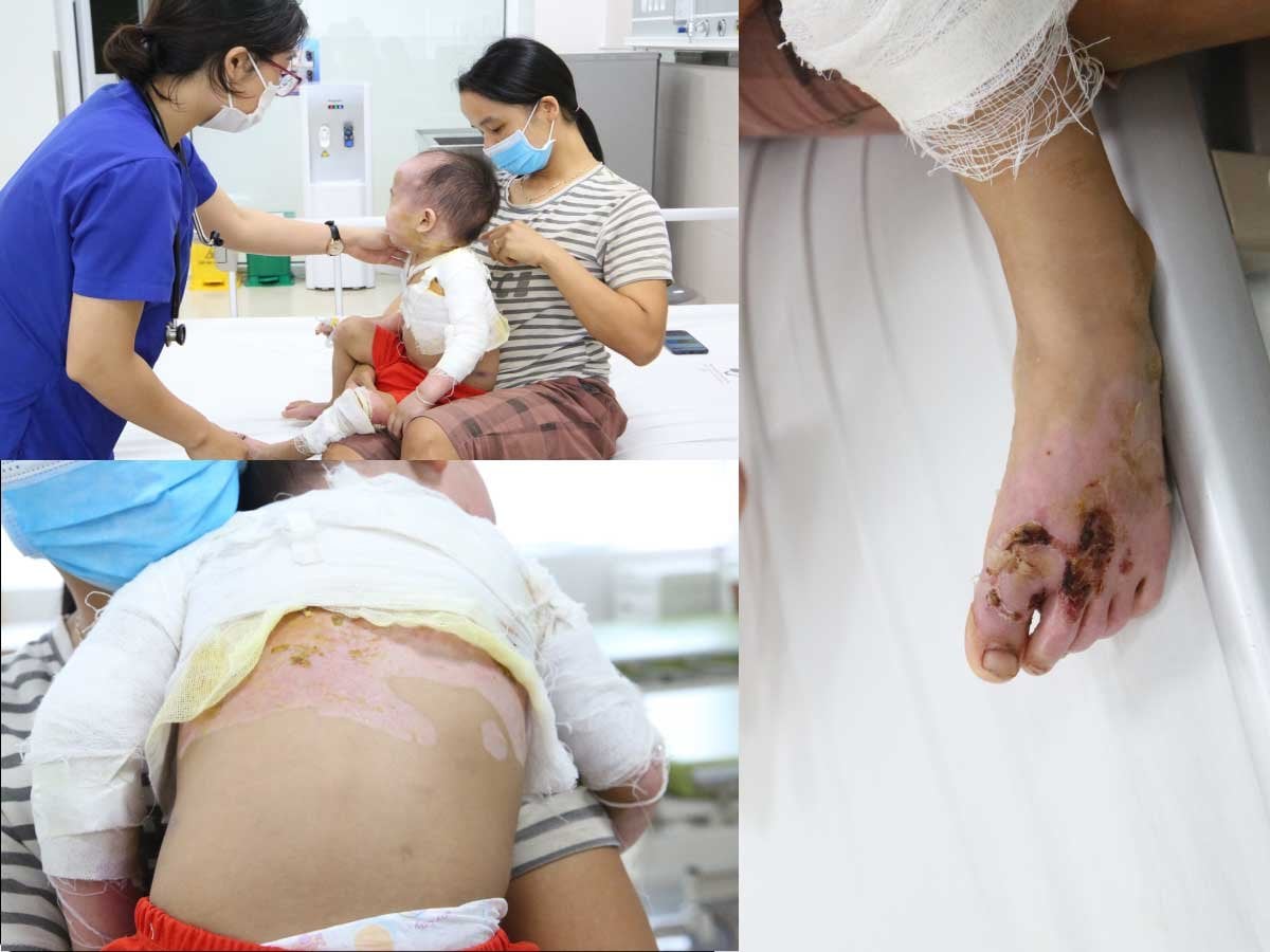 Bệnh viện cảnh b&aacute;o nhiều trường hợp tai nạn thương t&iacute;ch do trẻ nghỉ h&egrave; sớm tr&aacute;nh dịch COVID-19