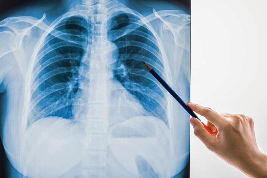 C&aacute;c b&aacute;c sĩ khuyến c&aacute;o kh&ocirc;ng n&ecirc;n lạm dụng việc chụp X-quang tim phổi v&agrave; chỉ n&ecirc;n đi kh&aacute;m hậu COVID-19 khi c&oacute; triệu chứng r&otilde; r&agrave;ng 