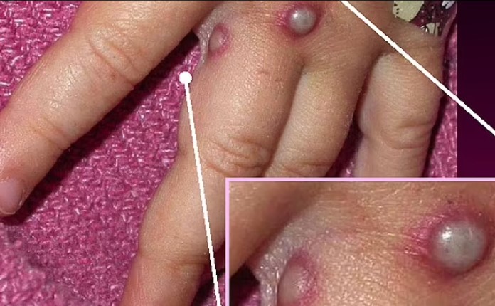 Với những g&igrave; m&agrave; c&aacute;c chuy&ecirc;n gia y tế thu thập đ&atilde; cho thấy c&oacute; một sự kh&aacute;c biệt đ&aacute;ng kể so với sự l&acirc;y lan trước đ&acirc;y ở miền Trung v&agrave; T&acirc;y Phi, nơi con người chủ yếu bị l&acirc;y nhiễm bởi c&aacute;c lo&agrave;i động vật v&agrave; kh&ocirc;ng l&acirc;y lan qua bi&ecirc;n giới.