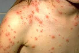 Ban của thủy đậu thường xuất hiện đầu ti&ecirc;n tr&ecirc;n mặt v&agrave; th&acirc;n