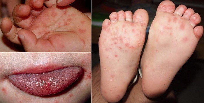 Ban ch&acirc;n tay miệng c&oacute; k&iacute;ch thước nhỏ hơn của đậu m&ugrave;a khỉ, chỉ từ 2-3mm v&agrave; tồn tại dưới 7 ng&agrave;y