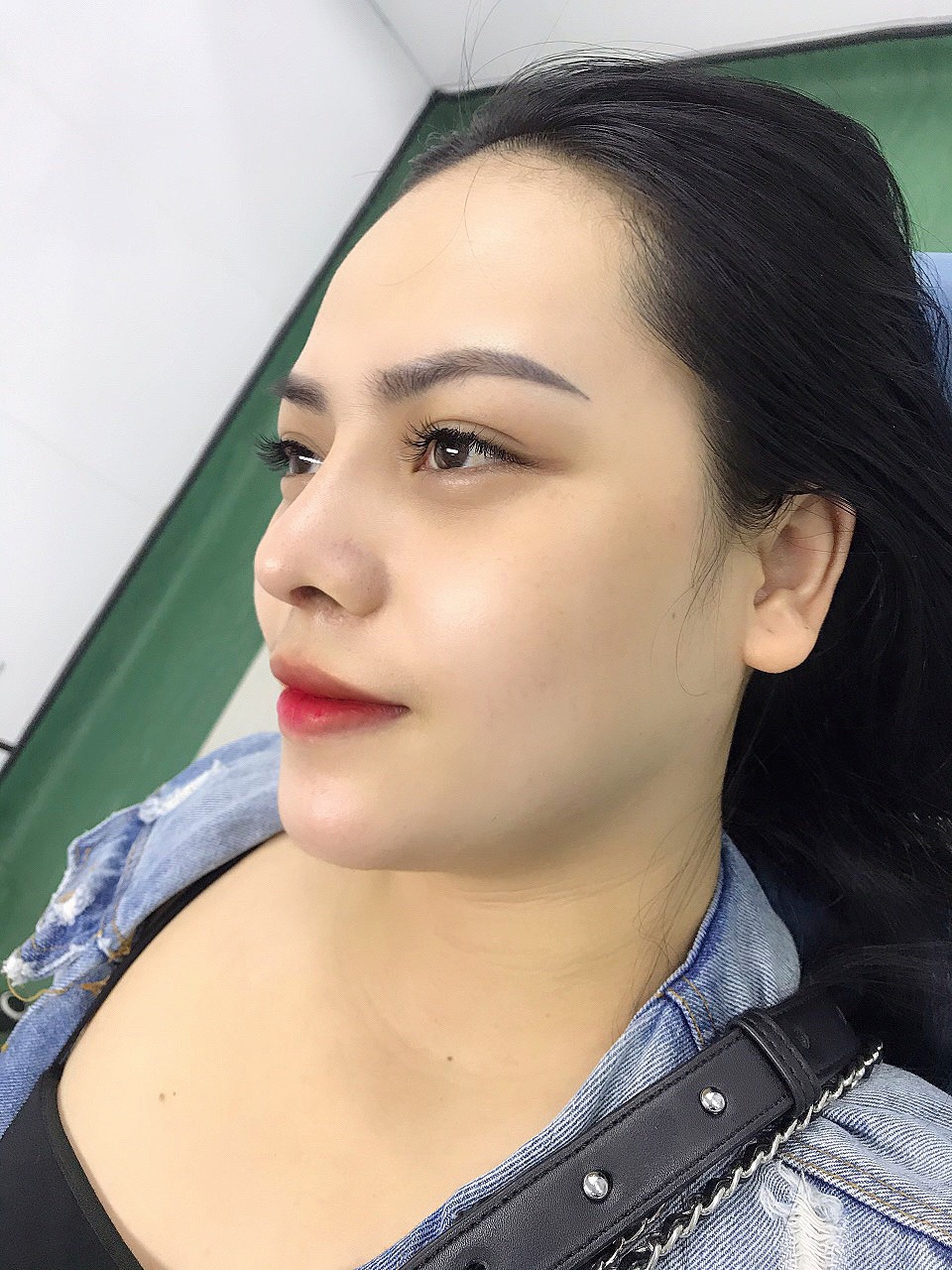 Khắc phục được hầu hết các khuyết điểm của mũi kể cả mũi bị biến chứng do phẫu thuật hỏng trước đó - Ảnh: Dr Đức Happy cung cấp
