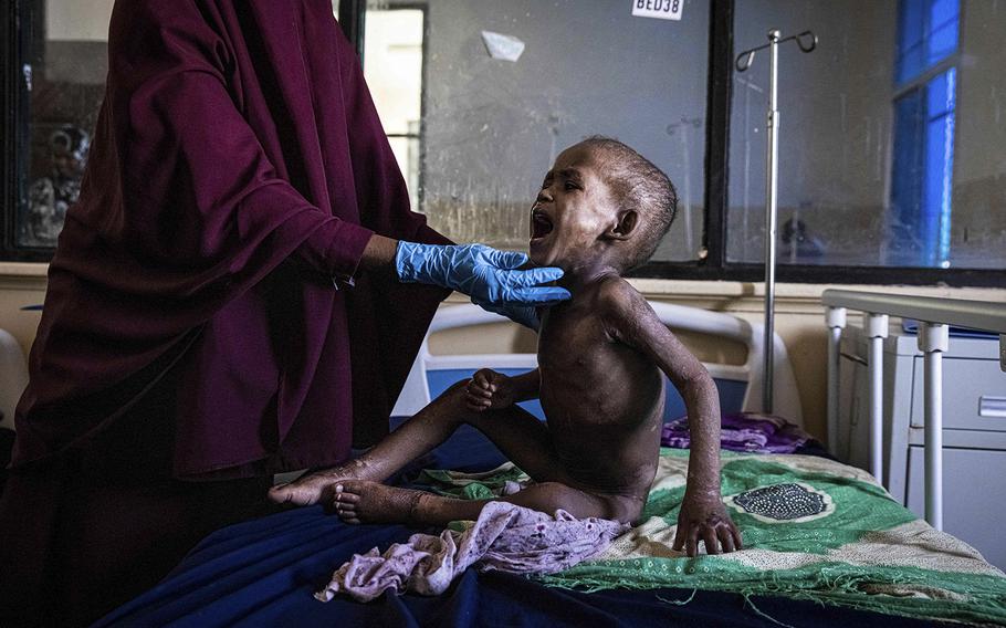 Ali Abdullahi Mohamed, cậu b&eacute; 27 th&aacute;ng tuổi bị suy dinh dưỡng nặng, được y t&aacute; kh&aacute;m để điều trị tại Bệnh viện Phụ sản v&agrave; Nhi đồng Banadir ở Mogadishu, Somalia, v&agrave;o ng&agrave;y 1 th&aacute;ng 6 năm 2022. Bốn m&ugrave;a mưa k&eacute;m li&ecirc;n tiếp đ&atilde; khiến h&agrave;ng triệu người phải chịu hạn h&aacute;n. người d&acirc;n ở Kenya, Somalia v&agrave; Ethiopia đang phải đối mặt với nạn đ&oacute;i. (Ed RamAFP/Getty Images/TNS))