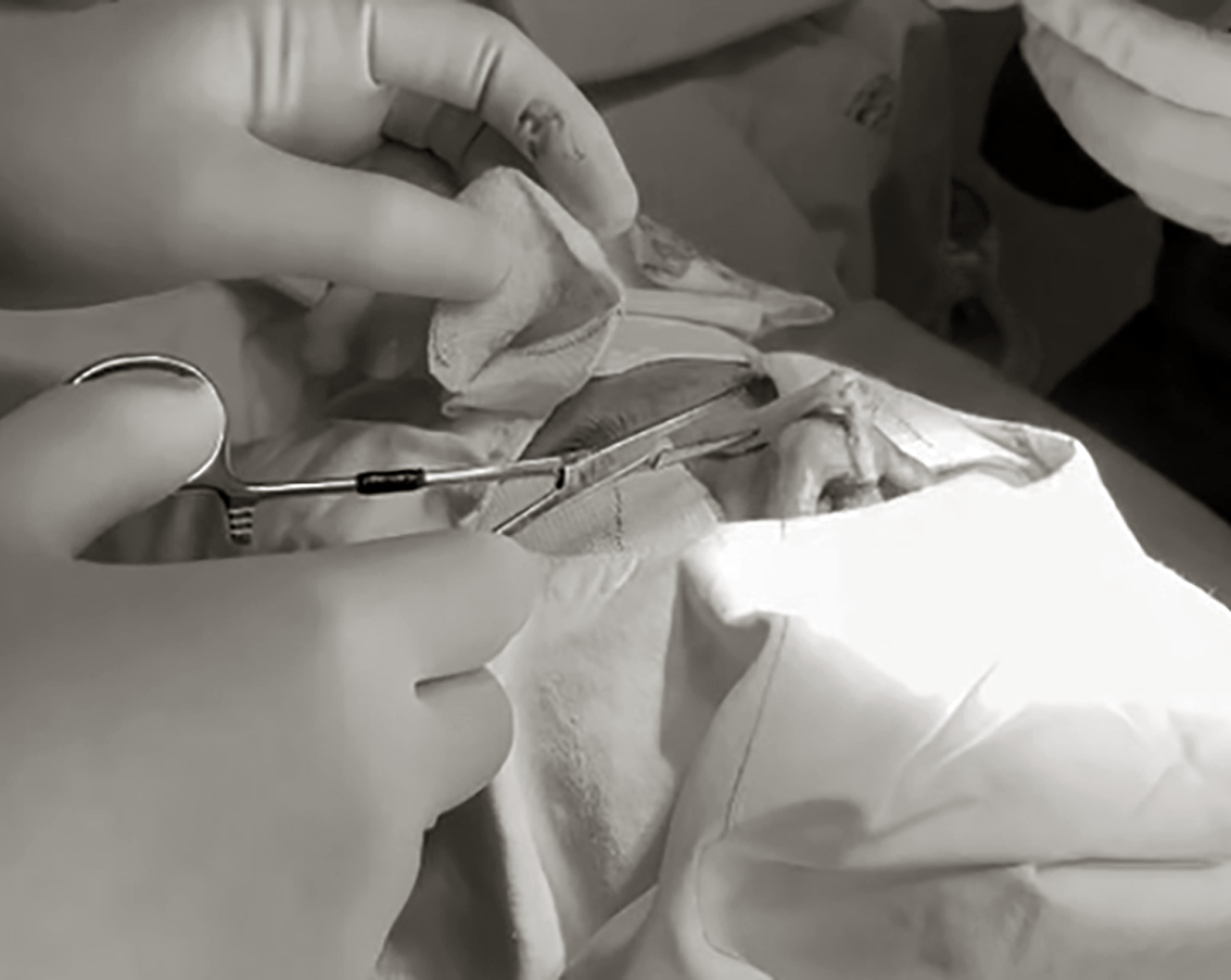 B&aacute;c sĩ phẫu thuật lấy thanh n&acirc;ng mũi cho một bệnh nh&acirc;n bị biến chứng v&igrave; l&agrave;m đẹp ở c&aacute;c cơ sở kh&ocirc;ng đủ ti&ecirc;u chuẩn - ẢNH: PHẠM AN