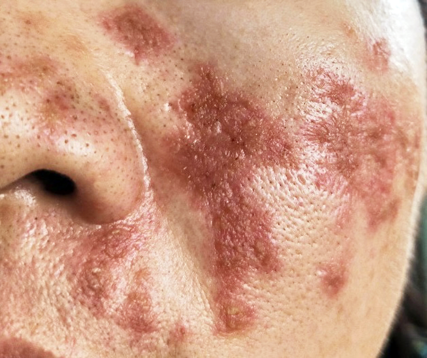 Bị bệnh tự miễn nhưng chị A. lại tưởng da mặt bị kh&ocirc;, đi spa c&agrave; da. Kết quả khiến chị bị biến chứng, &aacute;m ảnh tới mức rối loạn t&acirc;m thần - ẢNH: V.A