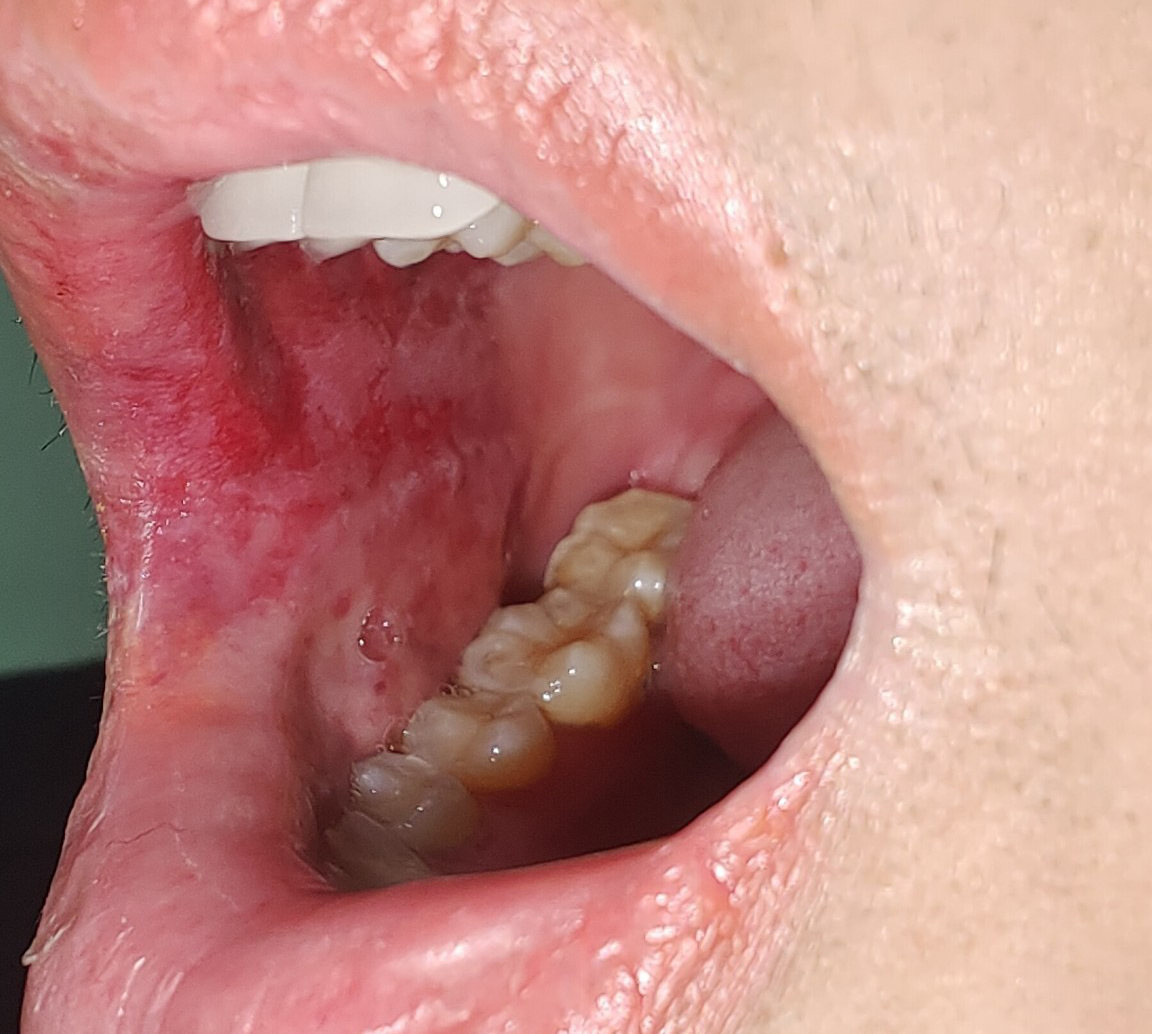 Trong miệng của bệnh nh&acirc;n, tại v&ugrave;ng m&aacute; cũng c&oacute; c&aacute;c vết trợt lo&eacute;t. Ảnh: Q. H.