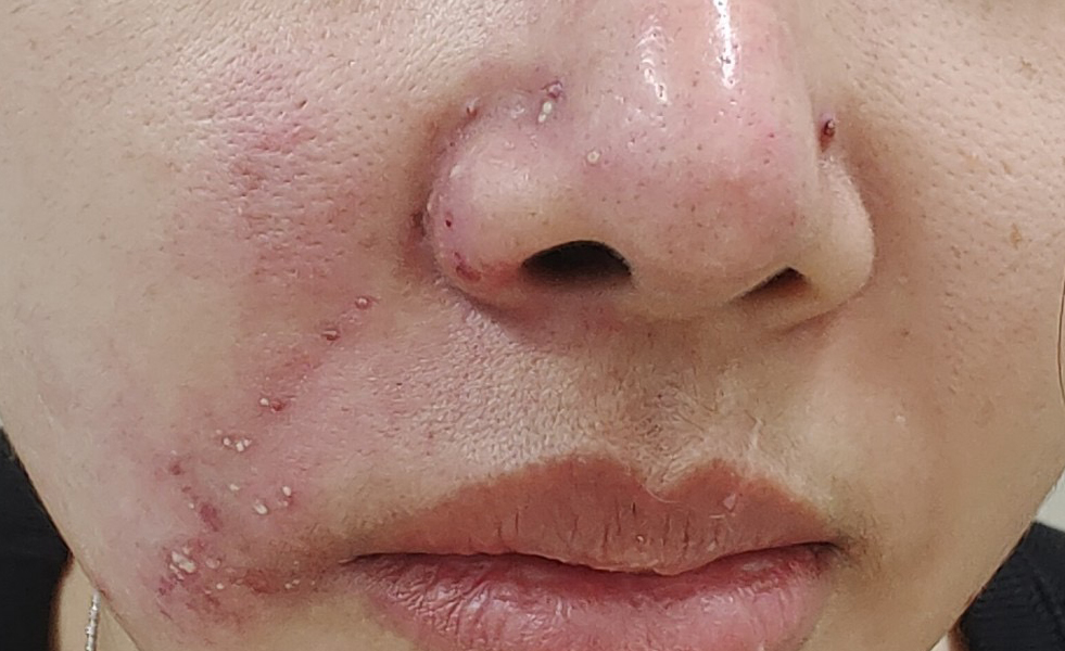 Tại c&aacute;c vị tr&iacute; ti&ecirc;m filler bị chảy mủ, khi si&ecirc;u &acirc;m b&aacute;c sĩ c&ograve;n ph&aacute;t hiện dưới da bệnh nh&acirc;n c&oacute; nhiều ổ mủ