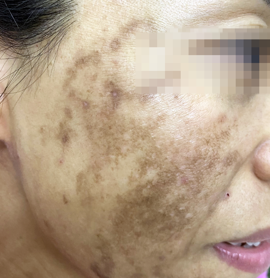 Một trường hợp bị tăng sắc tố sau vi&ecirc;m do bỏng da mặt v&igrave; đắp tỏi - ẢNH: L.V
