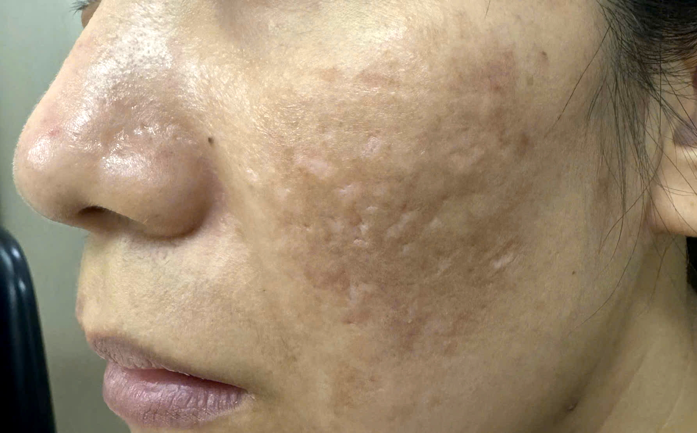 Một bệnh nh&acirc;n đến Khoa Da liễu - Thẩm mỹ da Bệnh viện Đại học y dược TPHCM kh&aacute;m do bị tổn thương sau khi điều trị n&aacute;m bằng laser tại một spa - ẢNH: L.V.