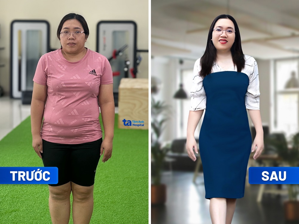 Chị Phạm Thị &Aacute;nh Dương giảm 7kg trong 3 th&aacute;ng tại Trung t&acirc;m Giảm c&acirc;n T&acirc;m Anh. Chị kh&ocirc;ng thấy mệt, kh&ocirc;ng mất sức, kh&ocirc;ng ki&ecirc;ng ăn qu&aacute; mức, kh&ocirc;ng bị stress - Ảnh: BVĐK T&acirc;m Anh