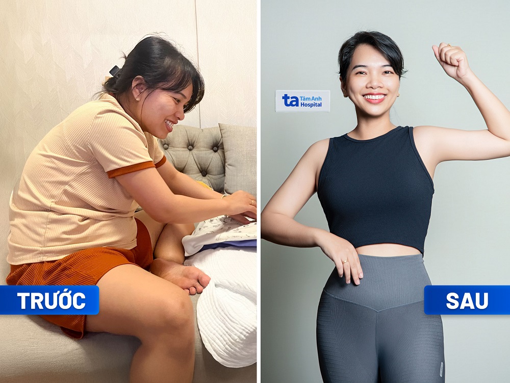 Chị Ng&ocirc; Trần Thanh Thảo - 34 tuổi, giảm 10kg, đẩy l&ugrave;i mỡ nội tạng. Chị cho biết giảm c&acirc;n kh&ocirc;ng thấy mệt, chi ph&iacute; hợp l&yacute; - Ảnh: BVĐK T&acirc;m Anh