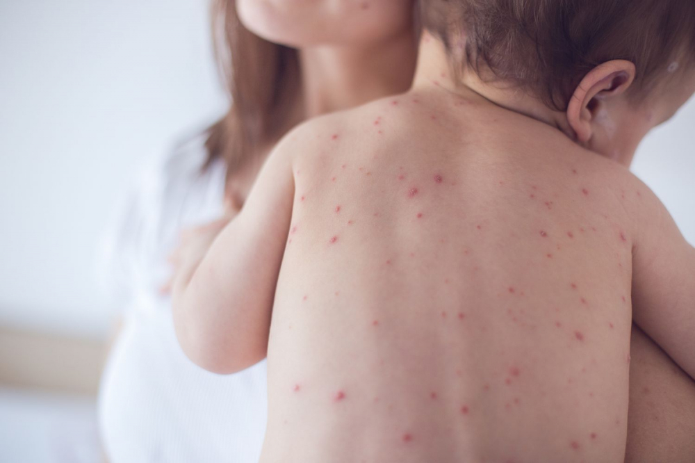 CDC H&agrave; Nội nhận định, số mắc sởi đang c&oacute; xu hướng tăng nhanh, chủ yếu ở người chưa ti&ecirc;m vắc xin hoặc chưa được ti&ecirc;m đầy đủ