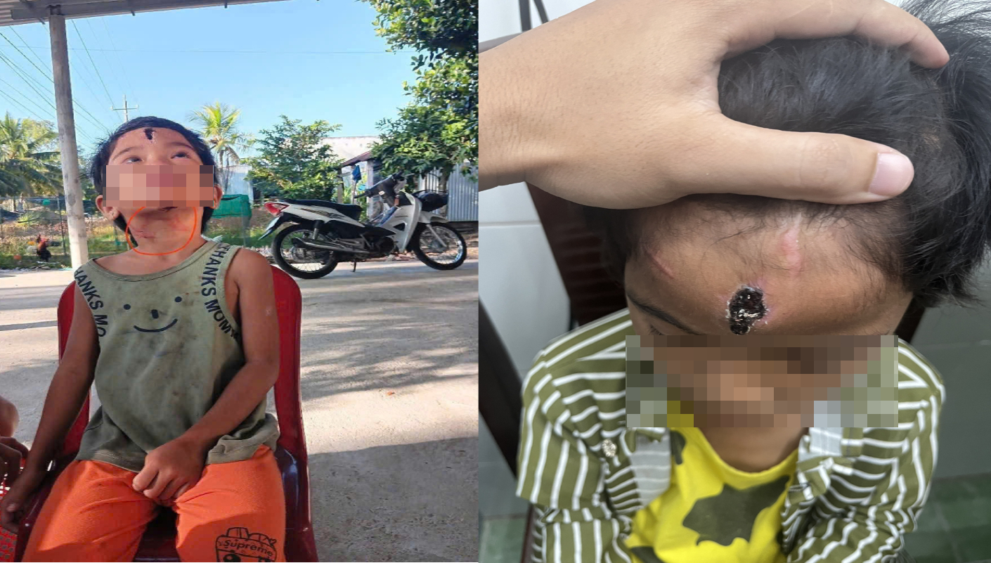 Ch&aacute;u N. bị cha dượng h&agrave;nh hạ với nhiều thương t&iacute;ch - Ảnh CACC