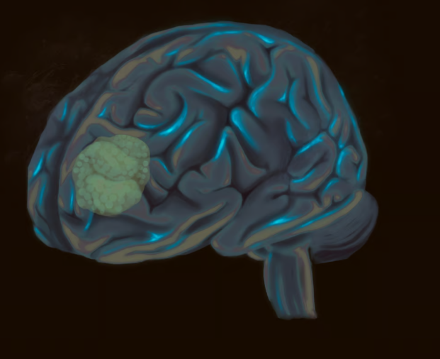 Một khối u đa dạng glioblastoma, được nh&igrave;n thấy ở th&ugrave;y tr&aacute;n của n&atilde;o. Ảnh: Shutterstock