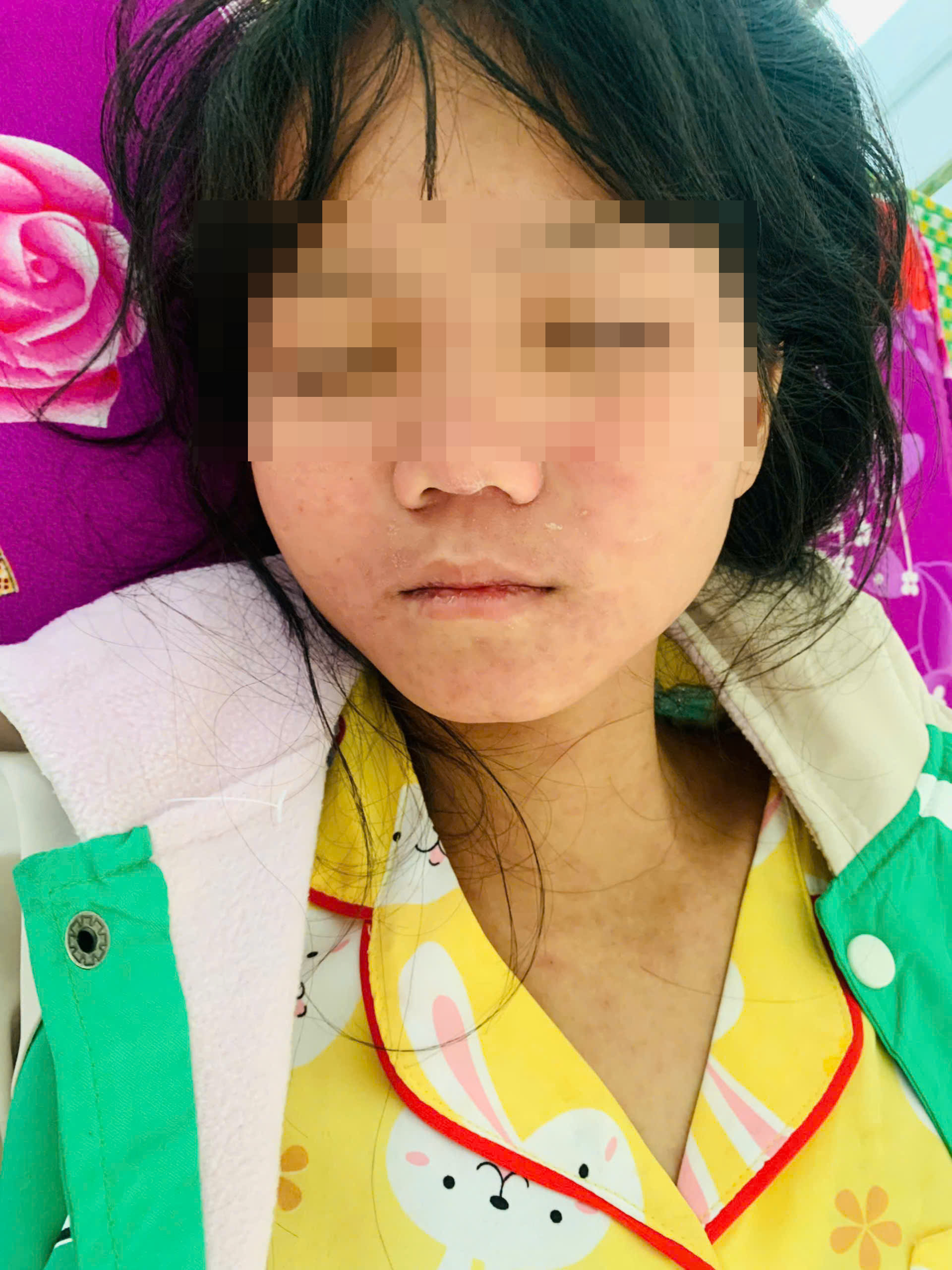 Một b&eacute; g&aacute;i bị nổi sốt ph&aacute;t ban
