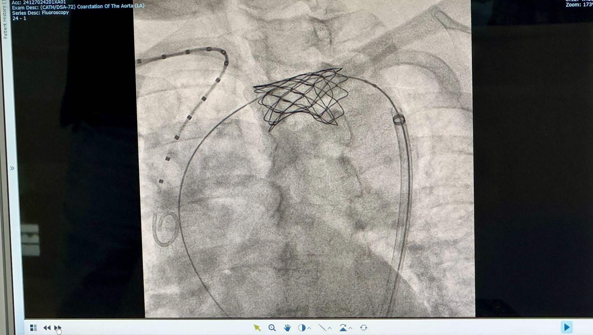 H&igrave;nh ảnh stent động mạch chủ được chụp lại sau khi đ&atilde; đặt th&agrave;nh c&ocirc;ng - Ảnh: FV