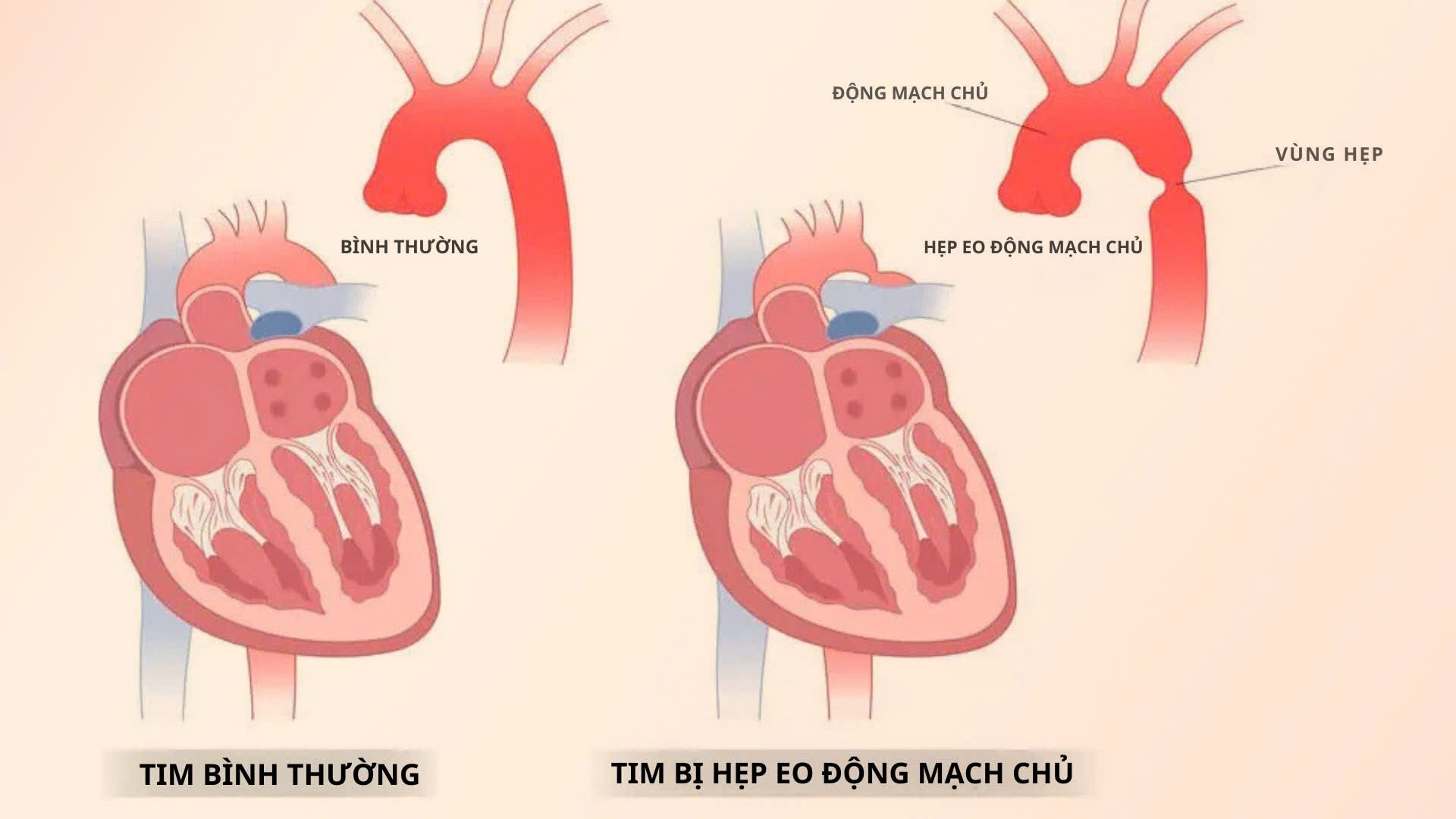 H&igrave;nh minh họa chứng hẹp eo động mạch chủ bẩm sinh g&acirc;y hạn chế lưu th&ocirc;ng m&aacute;u từ tim tới c&aacute;c cơ quan - Ảnh: Freepik