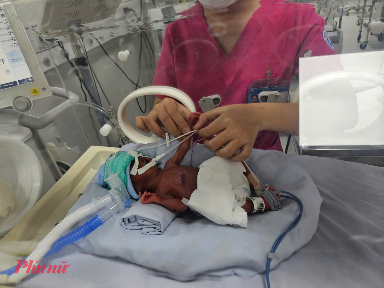 Chiến binh nh&iacute; nặng hơn 700gram, người đầy d&acirc;y nhợ nhưng lu&ocirc;n cố gắng từng ng&agrave;y