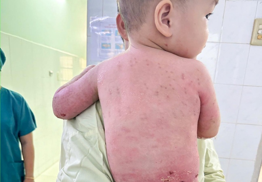 Nhờ kỹ thuật gh&eacute;p da, c&aacute;c vết bỏng tr&ecirc;n người b&eacute; T. gần như đ&atilde; l&agrave;nh lặn, ảnh BVCC