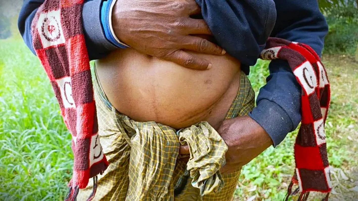 Vết sẹo tr&ecirc;n cơ thể Safiruddin sau lần b&aacute;n thận - ẢNH: AMINUL ISLAM MITHU (Al Jazeera)