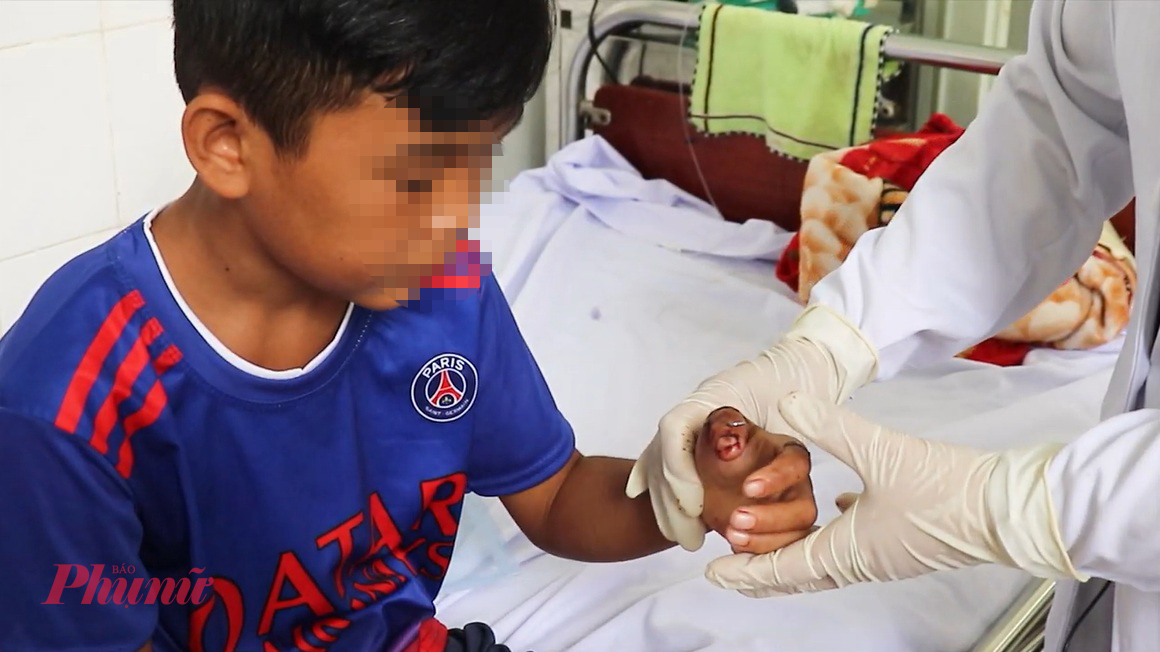 B&aacute;c sĩ kiểm tra vết thương cho em H. sau phẫu thuật