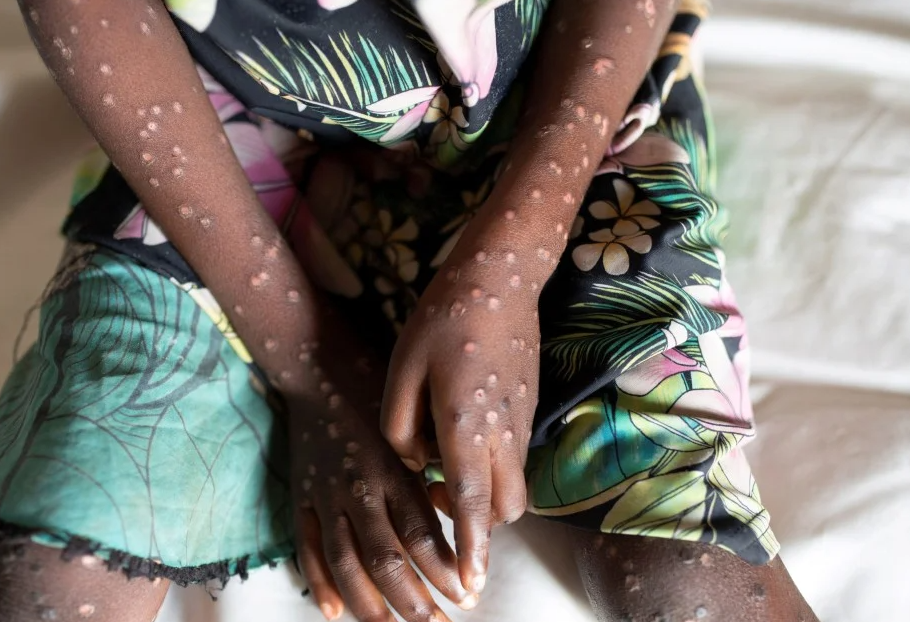WHO dỡ bỏ t&igrave;nh trạng khẩn cấp to&agrave;n cầu đối với Mpox ở Ch&acirc;u Phi, k&ecirc;u gọi cảnh gi&aacute;c li&ecirc;n tục