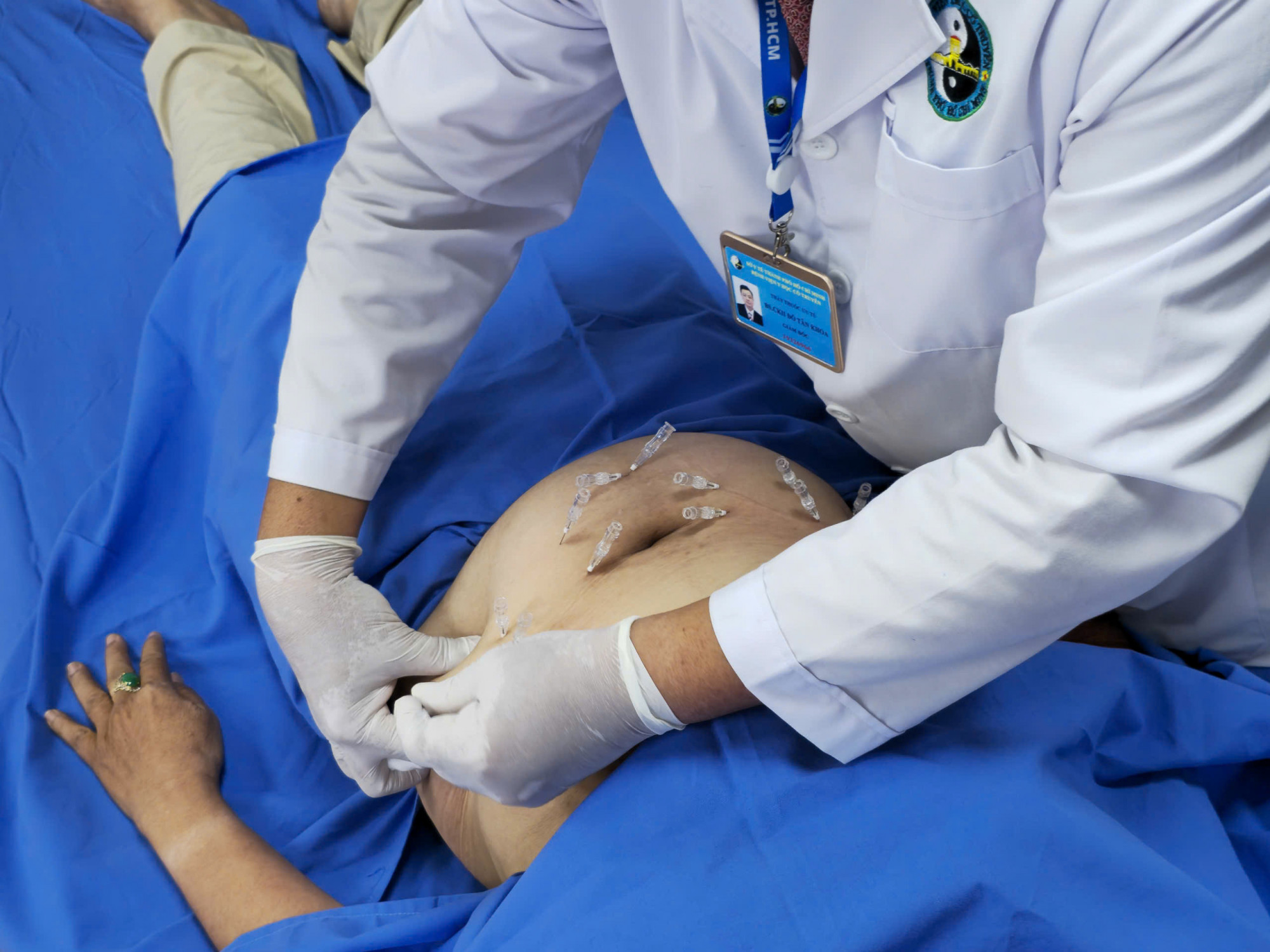 Ch&uacute; th&iacute;ch ảnh: Một bệnh nh&acirc;n đang được cấy chỉ huyệt đạo tại Bệnh viện Y học Cổ truyền TPHCM (ảnh: Đ. H.)