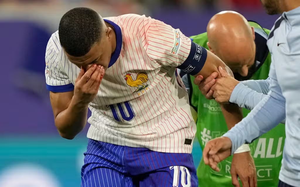 mbappe-roi-san-voi-cai-mui-day-mau-doi-tuyen-phap-thiet-hai-nang-ne (3).jpg