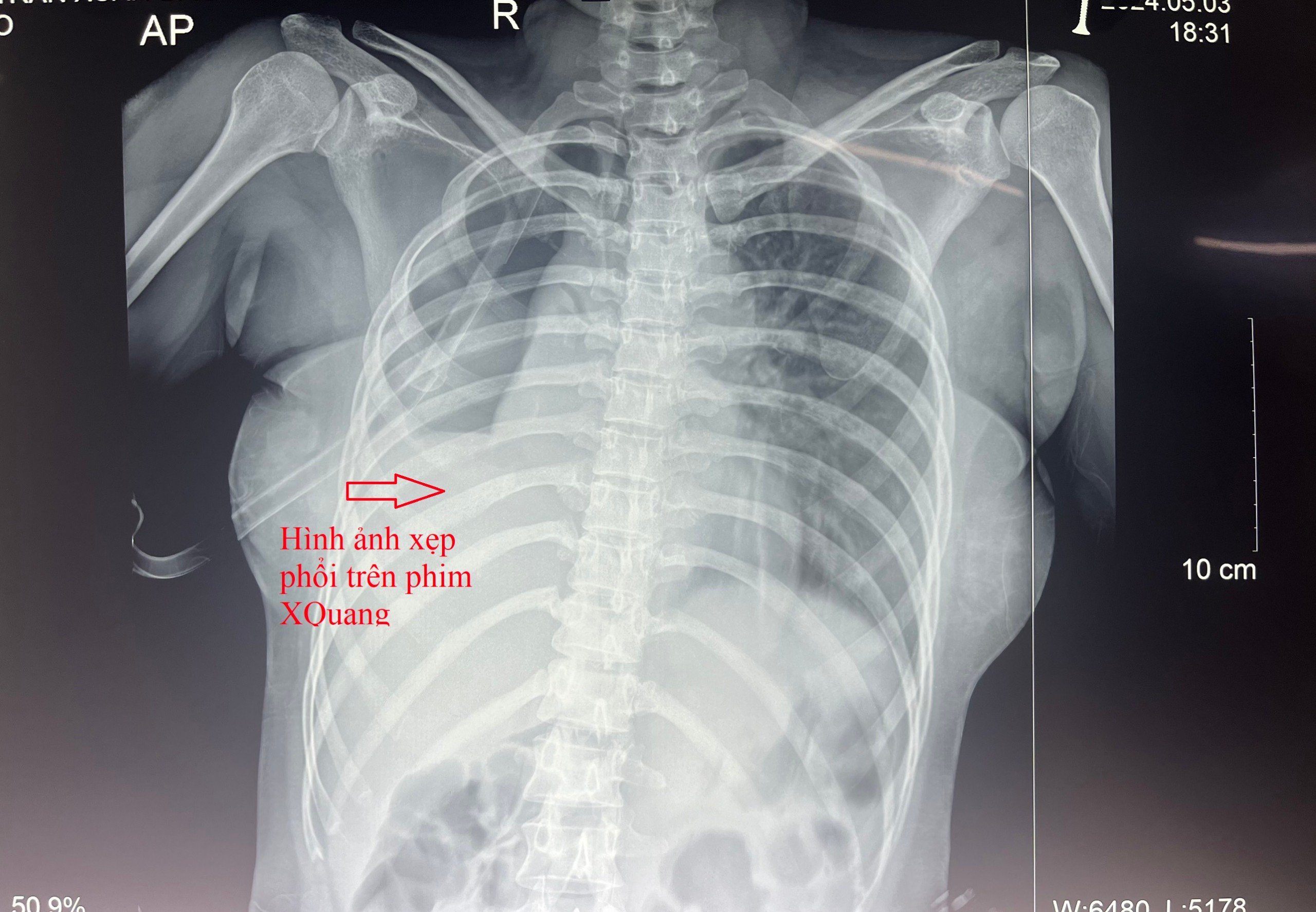đứt phế quản