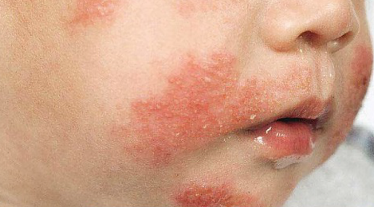 Cảnh báo dị ứng đạm sữa bò