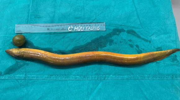 nhét con lươn 65 cm vào hậu môn.png