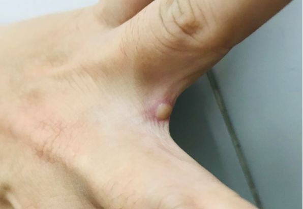 Vietnam reports 56 cases of monkeypox