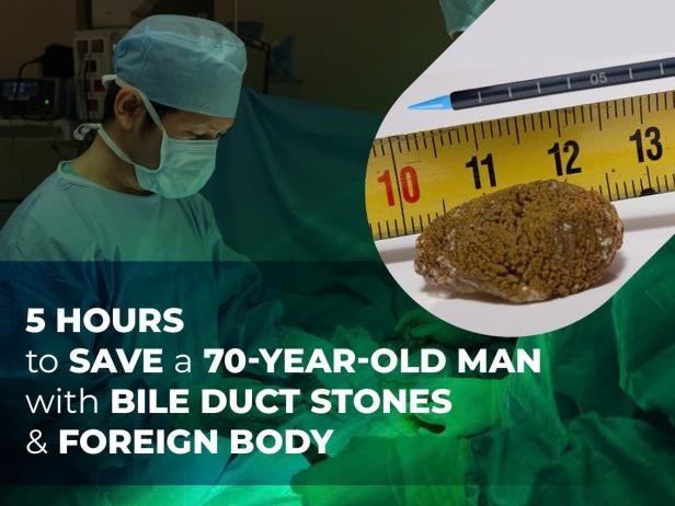 Five hours to save patient with bile duct stones