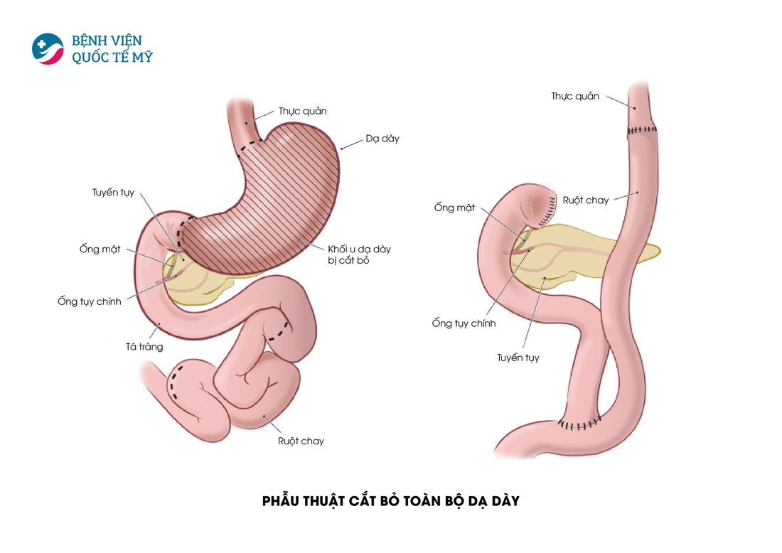 Hiểu về cơ chế điều trị ung thư thực quản, dạ dày - Ảnh 5.