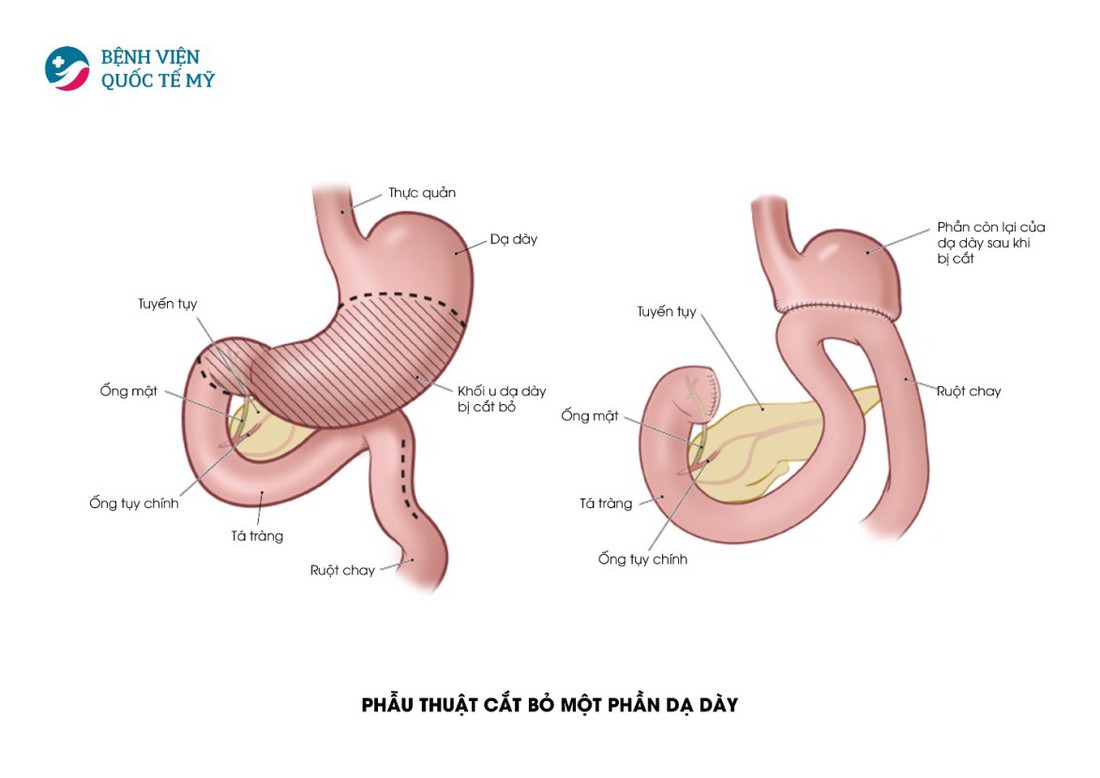 Hiểu về cơ chế điều trị ung thư thực quản, dạ dày - Ảnh 4.