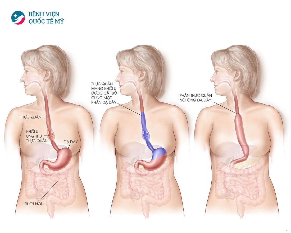 Hiểu về cơ chế điều trị ung thư thực quản, dạ dày - Ảnh 2.