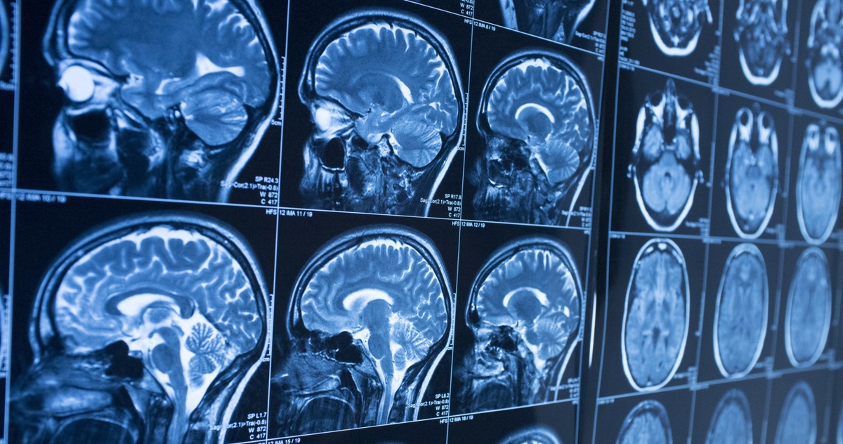 virus herpes gây ra bệnh Alzheimer