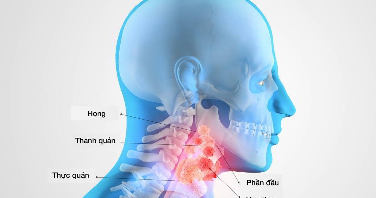Tai ù có thể do ung thư vòm họng