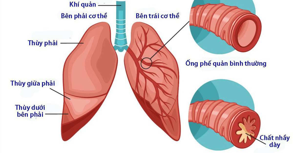 Phân biệt viêm phế quản do virus và viêm phế quản do vi khuẩn - Tuổi Trẻ  Online
