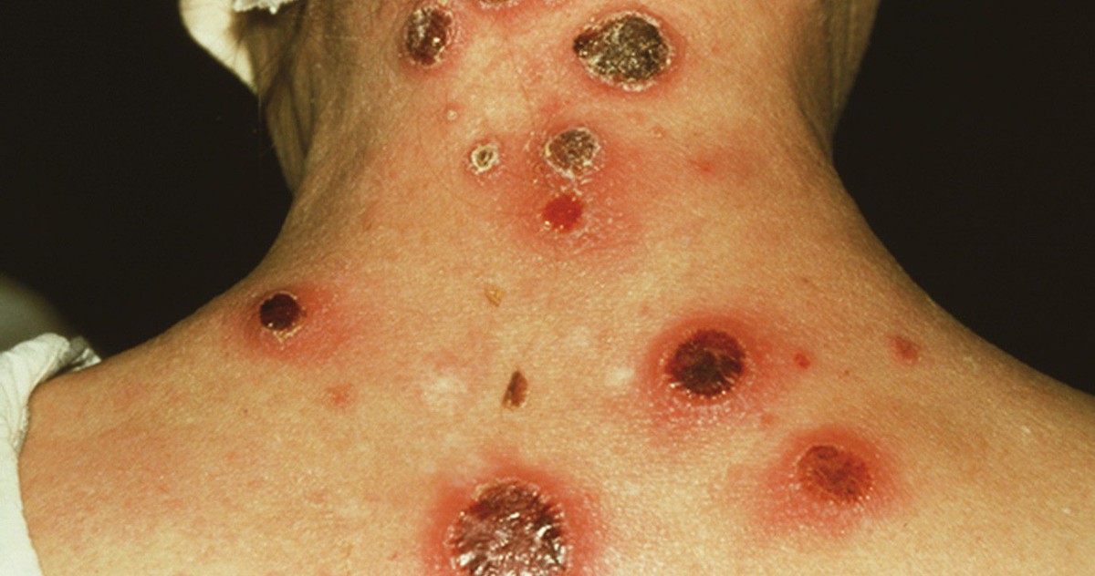 Biến chứng của bệnh giang mai - Tuổi Trẻ Online