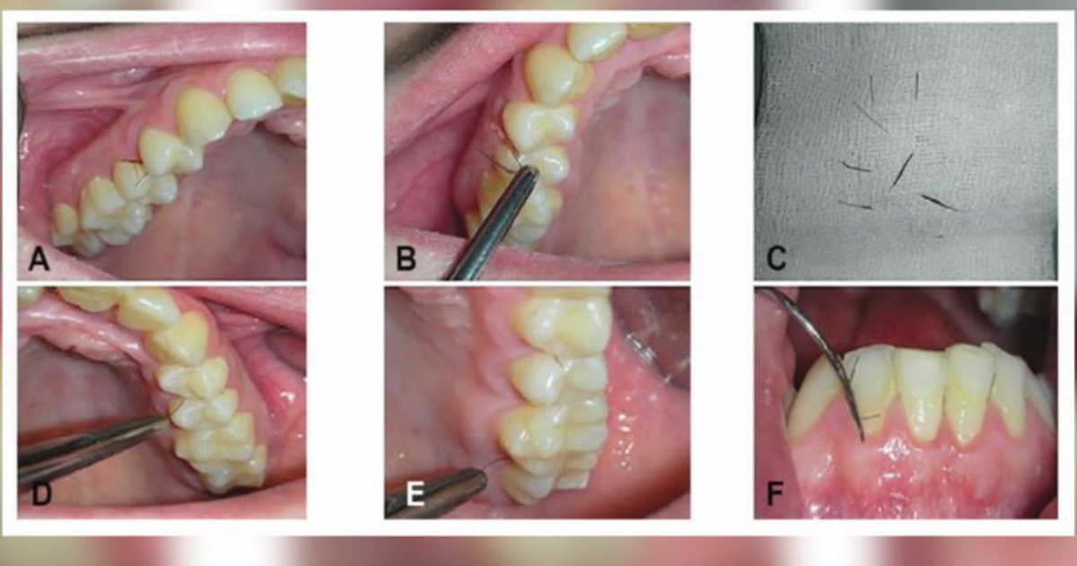 Mắc bệnh lạ, người phụ nữ mọc lông ở… lợi