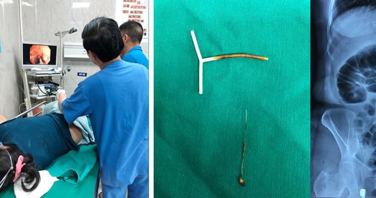 Vòng tránh thai xuyên thủng đại tràng người phụ nữ hơn 60 tuổi