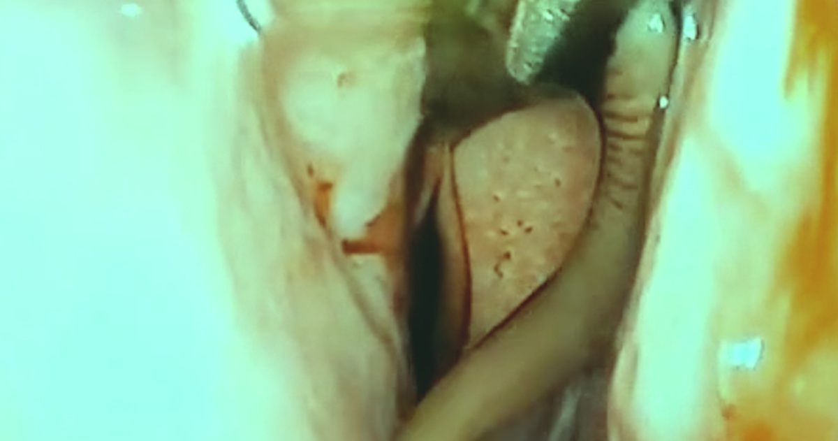 Video: Gắp con đỉa 5cm sống trong mũi thiếu niên 14 tuổi ở Nghệ An - Tuổi Trẻ Online